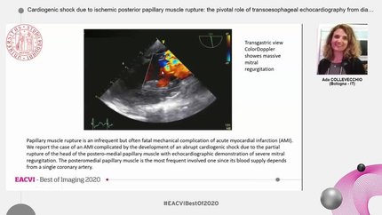 Cardiogenic shock due to ischemic posterior papillary muscle rupture: the pivotal role of transoesophageal echocardiography from diagnosis to treatment.