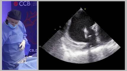 Live case session: LAA occluder in difficult cases