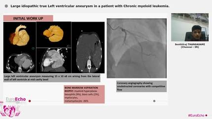 Large idiopathic true Left ventricular aneurysm in a patient with Chronic myeloid leukemia.
