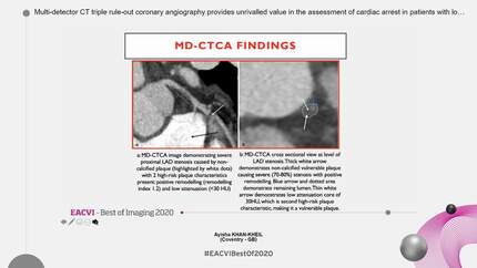 Multi-detector CT triple rule-out coronary angiography provides unrivalled value in the assessment of cardiac arrest in patients with low to intermediate probability of coronary artery disease.