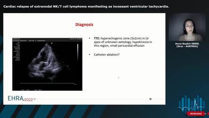 Cardiac relapse of extranodal NK/T cell lymphoma manifesting as incessant ventricular tachycardia.