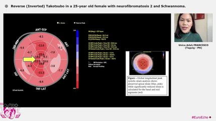 Reverse (Inverted) Takotsubo in a 25-year old female with neurofibromatosis 2 and Schwannoma.