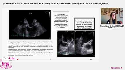 Undifferentiated heart sarcoma in a young adult:  from differential diagnosis to clinical management.