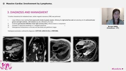 Massive Cardiac Involvement by  Lymphoma.