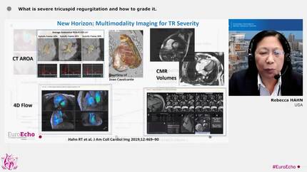 A new rising star: advances in tricuspid valve regurgitation 