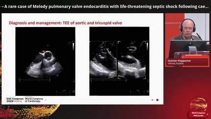 A rare case of Melody pulmonary valve endocarditis with life-threatening septic shock following caeserian section in a young woman