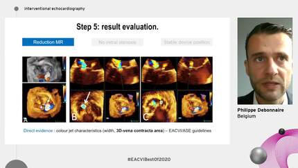 Interventional echocardiography