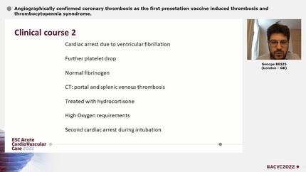 Angiographically confirmed coronary thrombosis as the first presetation vaccine induced thrombosis and thrombocytopennia synndrome.