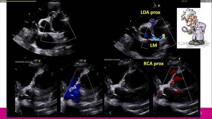A unusual case of giant coronary aneurysm: role of multimodality imaging in the diagnosis and follow-up