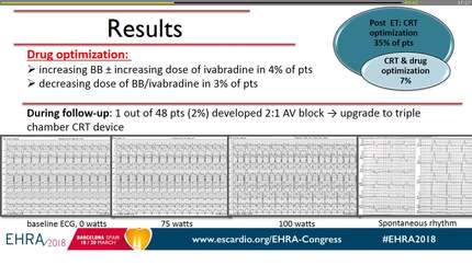 CRT follow-up in LV only pacing without RV lead: exercise test is essential.