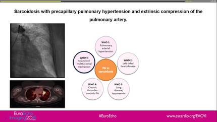 A case of pulmonary sarcoidosis with severe precapillary pulmonary hypertension and extrinsic compression of the pulmonary artery