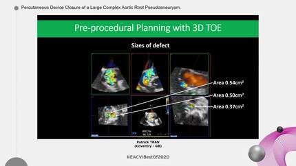 Percutaneous Device Closure of a Large Complex Aortic Root Pseudoaneurysm.