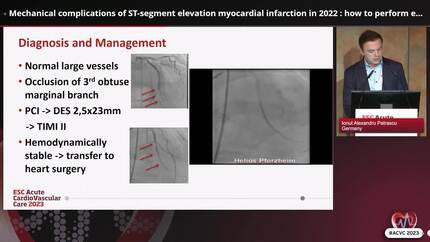 Mechanical complications of ST-segment elevation myocardial infarction in 2022 : how to perform echocardiography in the emergency department