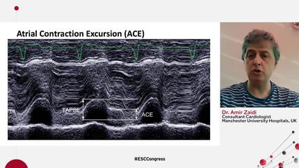 AV synchronous pacing using a single chamber leadless pacemaker.