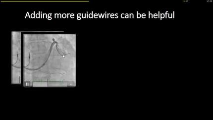 The use of snaring  techniques in CRT.
