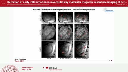 Detection of early inflammation in myocarditis by molecular magnetic resonance imaging of activated platelets