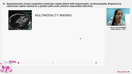 Spontaneously closed congenital ventricular septal defect with hypertrophic cardiomyopathy disguised as ventricular septal rupture in a patient with acute anterior myocardial infarction.