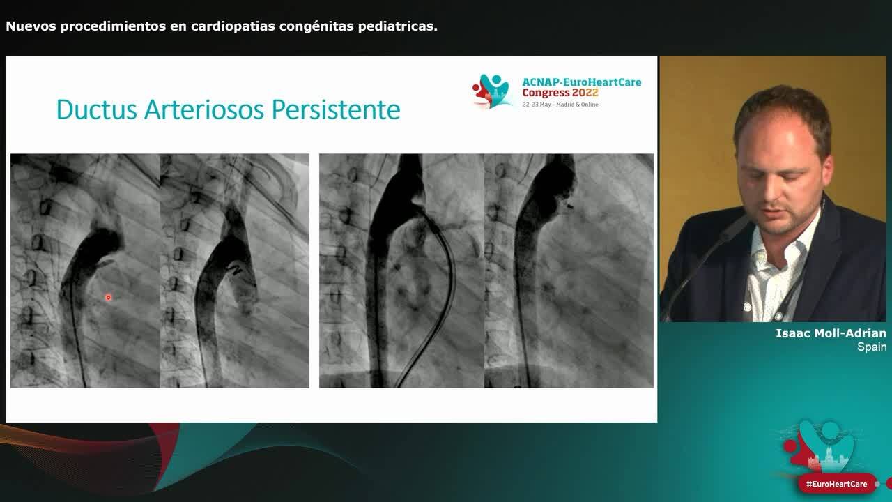 Nuevos procedimientos en cardiopatias congénitas pediatricas.