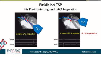Trans septal puncture, what’s the nurses role: complications that can arise.
Transseptal punktion, die rolle der krankenschwester: komplikationen das auftreten kann.
