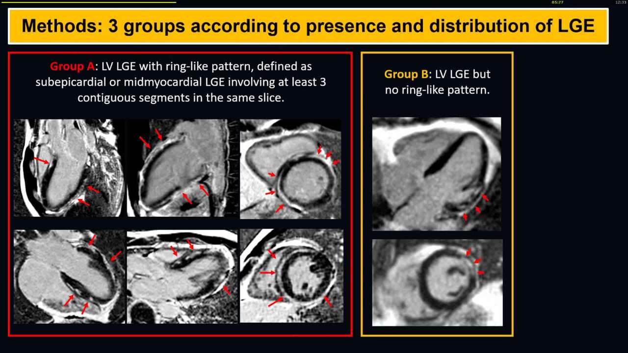 Prognostic value of non-ischemic ring-like left ventricular scar pattern in patients with apparently idiopathic ventricular arrhythmias: a CMR imaging study