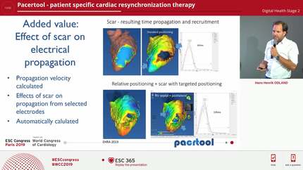 Pacertool - patient specific cardiac resynchronization therapy