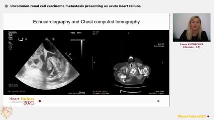 Uncommon renal cell carcinoma metastasis presenting as acute heart failure.