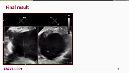 Percutaneous removal of right ventricular papillary fibroelastoma  