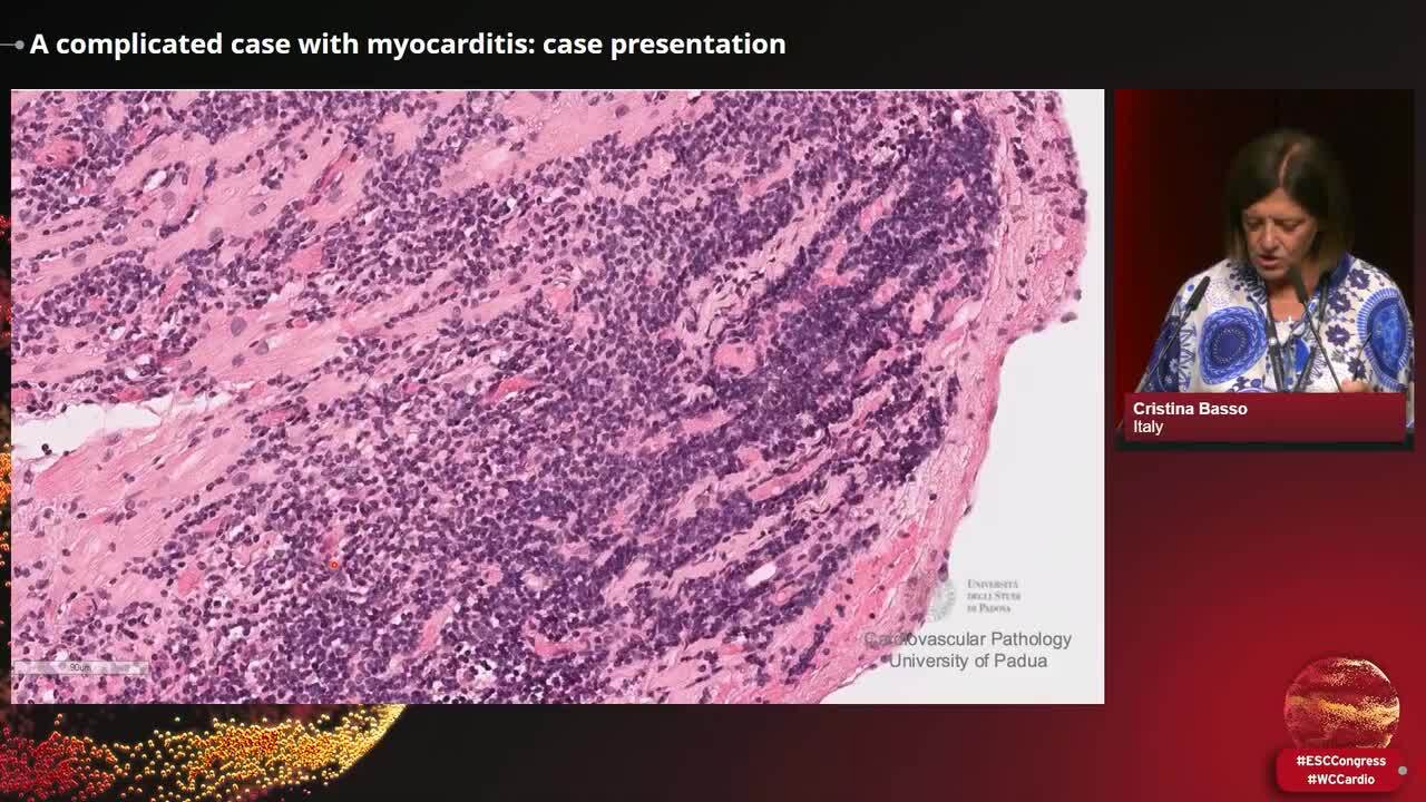 A complicated case with myocarditis: case presentation
