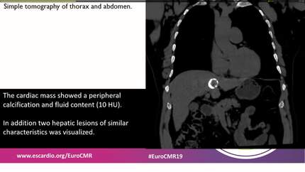 Not all myocardial masses are tumors.