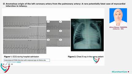 Anomalous origin of the left coronary artery from the pulmonary artery: A rare potentially fatal case of myocardial infarction in infancy.