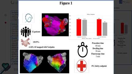 Real-world experience of atrial fibrillation ablation using a variable-loop circular catheter: a single-centre study
