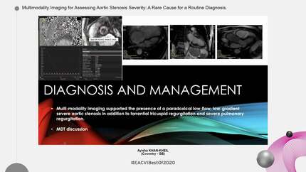 Multimodality Imaging for Assessing Aortic Stenosis Severity: A Rare Cause for a Routine Diagnosis.