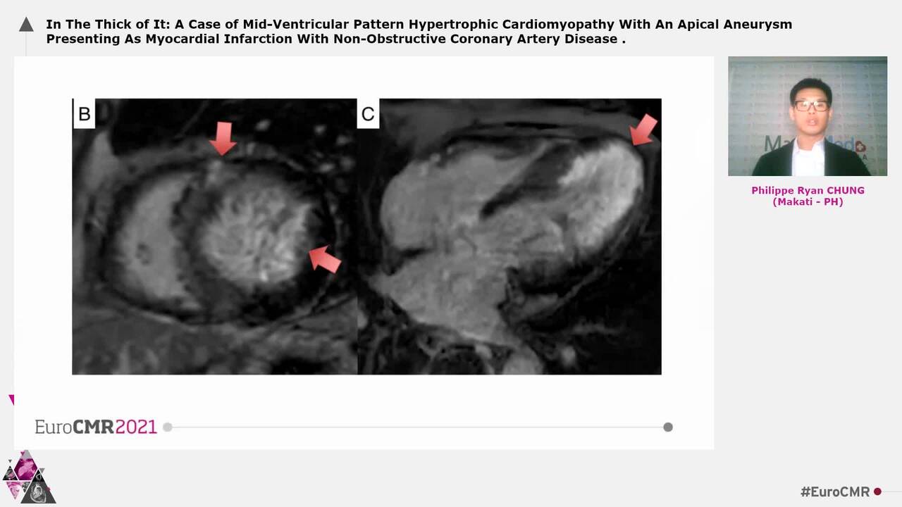 In The Thick of It: A Case of Mid-Ventricular Pattern Hypertrophic Cardiomyopathy With An Apical Aneurysm Presenting As Myocardial Infarction With Non-Obstructive Coronary Artery Disease
.