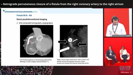 Retrograde percutaneous closure of a fistula from the right coronary artery to the right atrium
