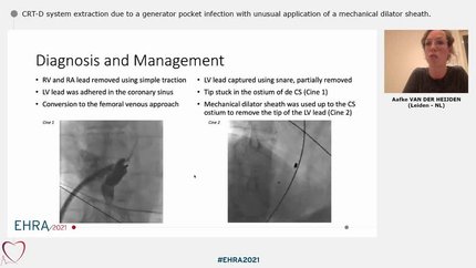 CRT-D system extraction due to a generator pocket infection with unusual application of a mechanical dilator sheath.