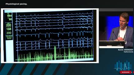 Live case session: physiological pacing