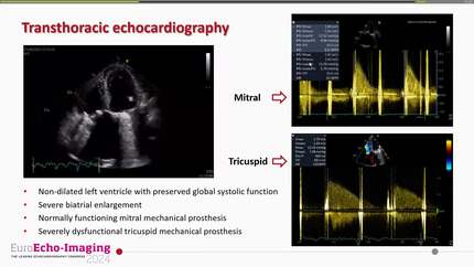 Rheumatic heart disease – how many interventions and complications can a patient overcome?