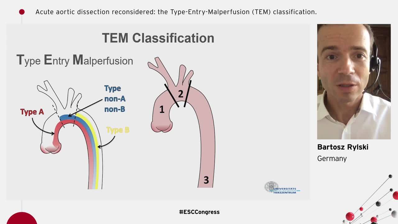 Acute aortic dissection reconsidered: the Type-Entry-Malperfusion (TEM) classification.