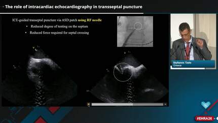 How to perform safe transseptal puncture?