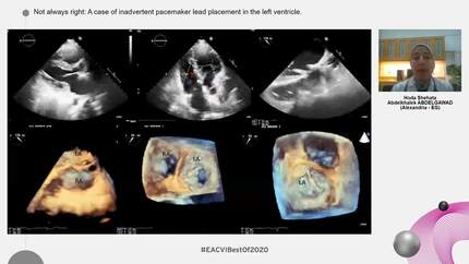 Not always right: A case of inadvertent pacemaker lead placement in the left ventricle.