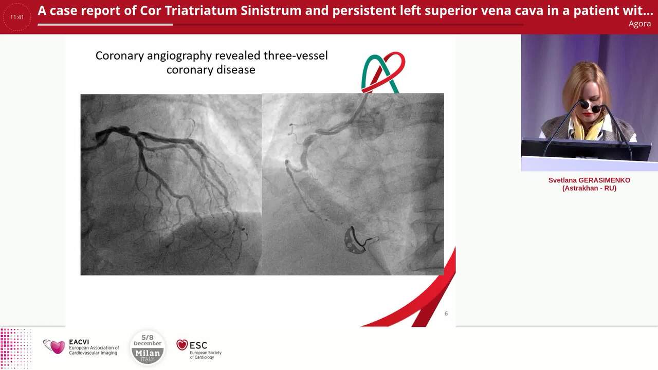 A case report of Cor Triatriatum Sinistrum and persistent left superior vena cava in a patient with multi-vessel coronary artery disease