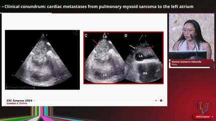 Clinical conundrum: cardiac metastases from pulmonary myxoid sarcoma to the left atrium