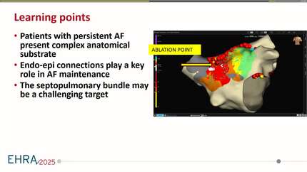 Septopulmonary bundle as a target in AF REDO ablation