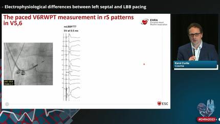 Electrophysiological differences between left septal and LBB pacing