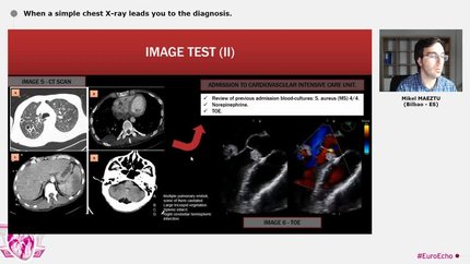 When a simple chest X-ray leads you to the diagnosis.