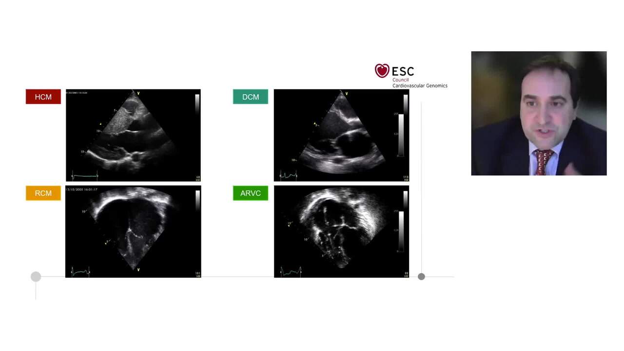 Interpretation and actionability of genetic variants in cardiomyopathies