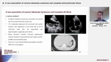 A rare association of reverse takotsubo syndrome and complete atrioventricular block.