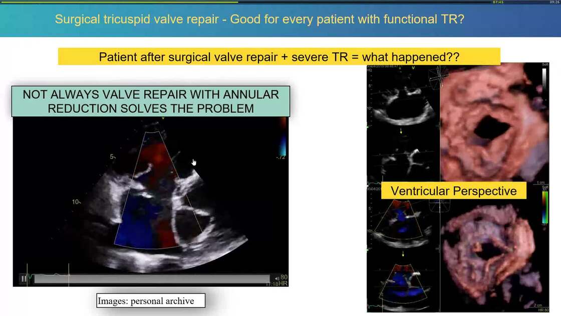 Esc Anatomical Details Of The Tricuspid Valve By D Echocardiography