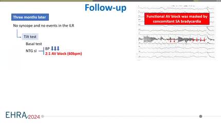 Cardioneuroablation in neuromediated syncope unmasks functional AV block