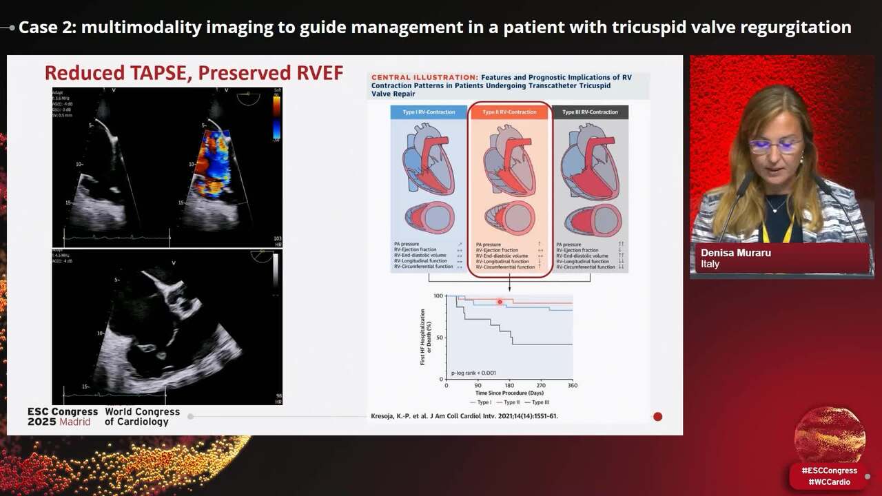 Clinical Case Management: how multimodality imaging guides management in mitral and tricuspid regurgitation